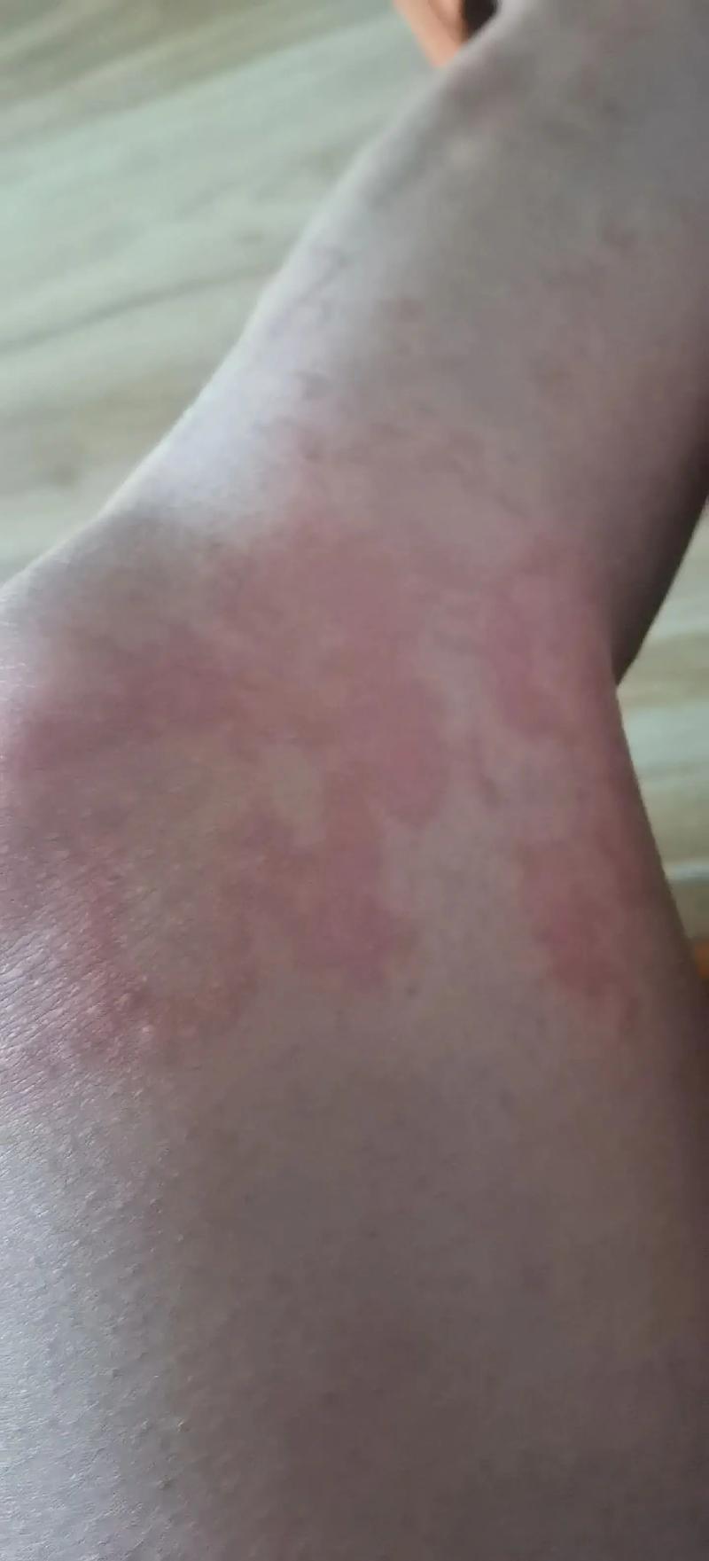 荨麻疹的痛苦 一个星期了,越来越严重,晚上根本睡不了觉!好