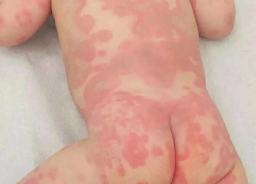 不是所有发烧出疹都是幼儿急疹 这几种情况必须就医