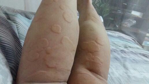 一文了解 荨麻疹的分类 危害和护理等不得不知的8个小知识