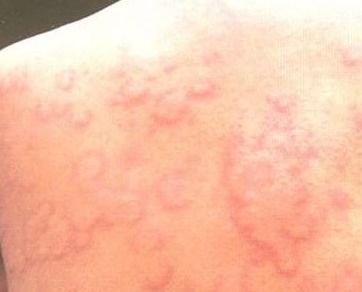 荨麻疹可以治愈吗