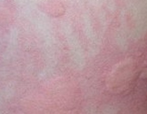 得了荨麻疹病的症状是什么样子的