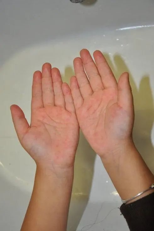 作为湿疹的常年患者,治疗这条路上,我用过的方法太多