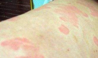 什么是胆碱能性荨麻疹