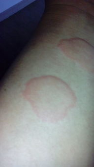 去医院医生检查是荨麻疹,停药两天又发作了,问一下有偏方吗