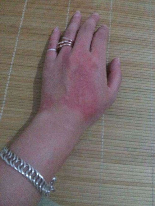 急性荨麻疹 百科