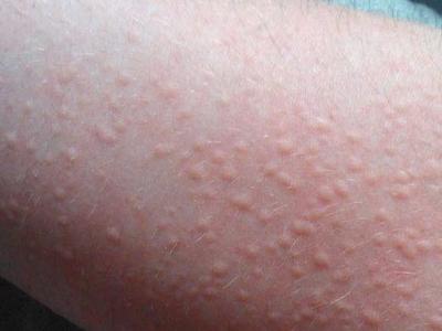 荨麻疹与某些营养素缺乏有关吗?