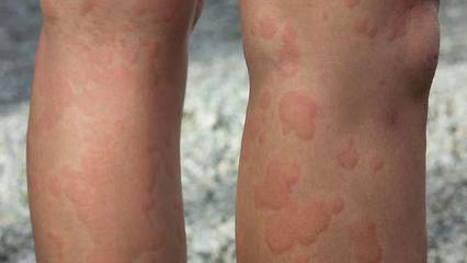 冬季,谨防寒冷性荨麻疹,病情严重的会出现胸闷、心悸、腹痛、晕厥甚至休克!