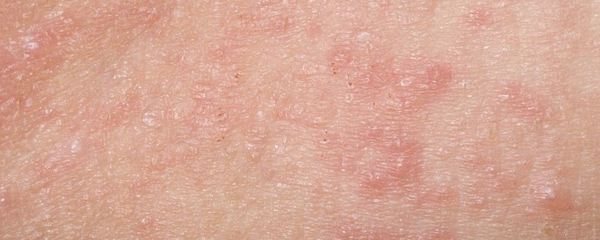 孩子患上荨麻疹怎么办 哪些方法治疗管用