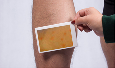 荨麻疹患者饮食上应该注意什么