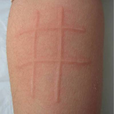 秋季荨麻疹高发,全身发痒,艾灸这几个穴位有奇效