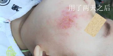 杏璞霜竟比医院开的激素药膏还管用