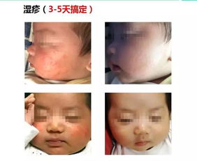 妙抚多肽护理抑菌液 宝宝湿疹克星 细菌居然是被电死的