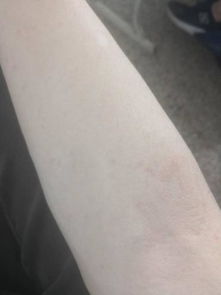 这个天一热就出现 据说是荨麻疹 该怎么治疗