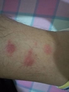 这是荨麻疹还是别的什么 一开始像蚊子咬的,有点肿,很痒,后来变