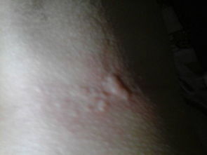 请问这属于荨麻疹吗