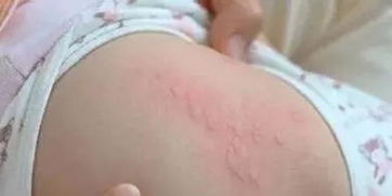 丘疹性荨麻疹 寻 上了宝宝怎么办