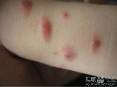 预防荨麻疹需要注意什么