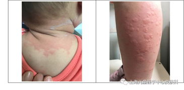 关于荨麻疹的疑问你都有答案了吗