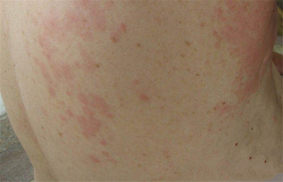 风寒性荨麻疹图片