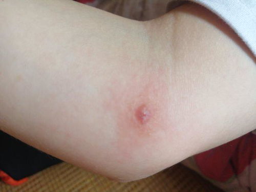 身上突然长了很多红疙瘩很痒,有的地方还长小水泡,不是荨麻疹,之前被蚂蚁咬过