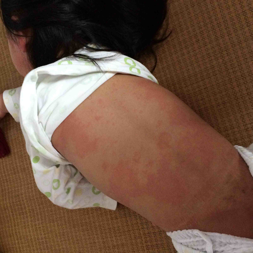 产后荨麻疹的症状图片