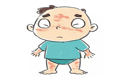 产后荨麻疹的症状图片