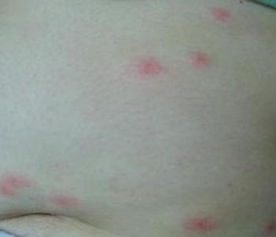 荨麻疹百科 症状、病因与治疗全面解析