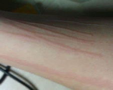 划痕性荨麻疹患者的护理方法