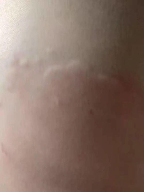 越重的荨麻疹越要注意饮食