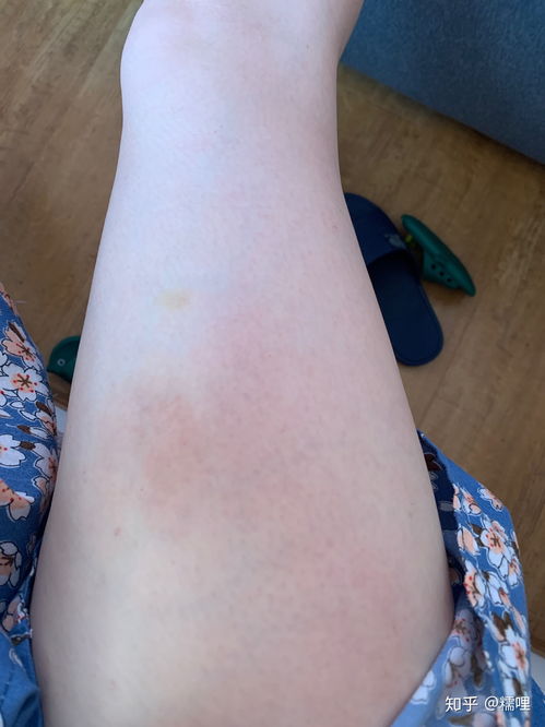 今年夏季荨麻疹与过敏性湿疹记录