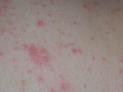秋季荨麻疹 成因、症状与防治方法