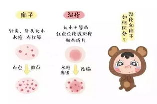 别把痱子当湿疹，小心加重孩子的病情 兼谈荨麻疹的识别与防治