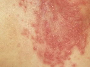 这些不是婴儿湿疹！宝爸宝妈必知的荨麻疹辨识指南