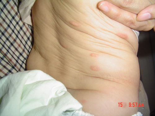 色素性荨麻疹与荨麻疹 异同与解析