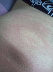 什么叫成熟 荨麻疹