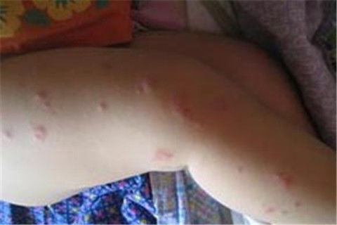 荨麻疹发病的主要因素