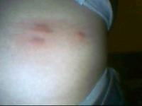 身上长红疙瘩，瘙痒难耐 湿疹还是荨麻疹？诊断与紧急处理指南