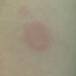 急性荨麻疹的治疗与护理