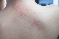 慢性荨麻疹莫要愁，中医药来帮忙