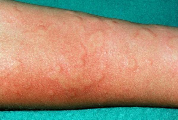 患者:荨麻疹能根治?医生:爱吃这3类食物,一辈子都别想治好它