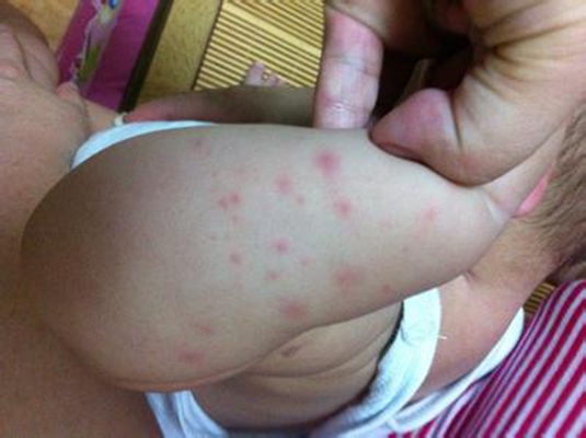 儿童荨麻疹 (49)