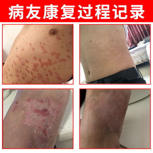 百草清肤膏 外用特效止痒膏，缓解牛皮癣、湿疹等多种皮肤问题