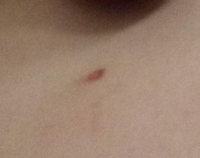 荨麻疹的发展与不当处理 从湿疹药物到皮肤损伤的四个月历程