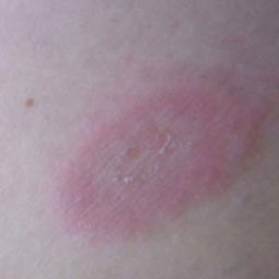 轻度湿疹与荨麻疹的常见症状及图片对照