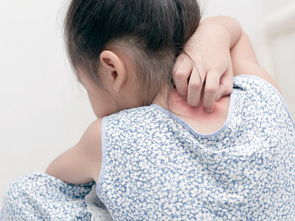 这些食品能改善荨麻疹等过敏体质吗？