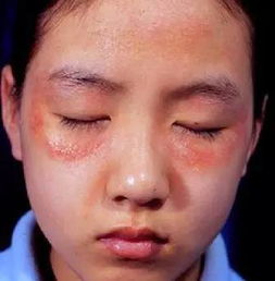 你必须了解的皮肤过敏真相 荨麻疹