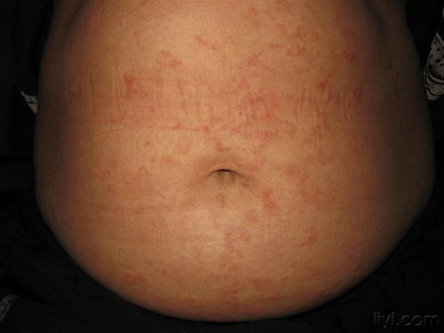 看图识病 如何辨别银屑病、湿疹与荨麻疹？