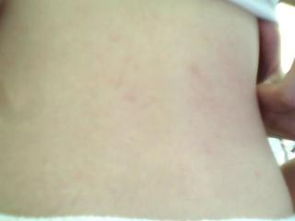 出汗后背部发痒，会是荨麻疹吗？