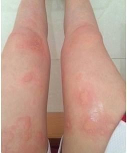 中医妙方 一种草叶子，止痒养颜，轻松应对荨麻疹