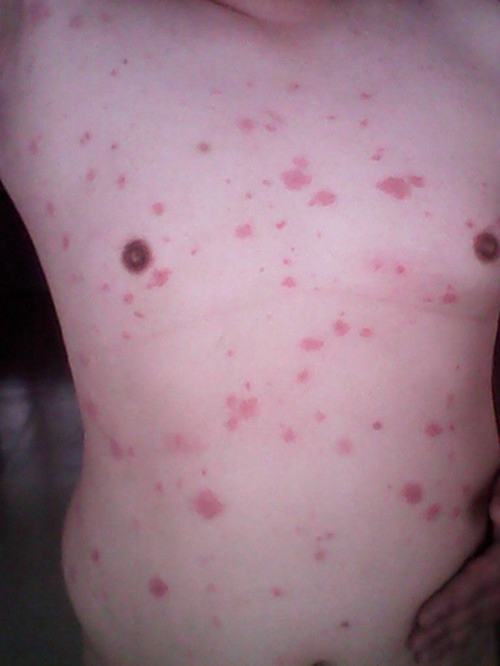 产后荨麻疹的症状与识别 图文详解